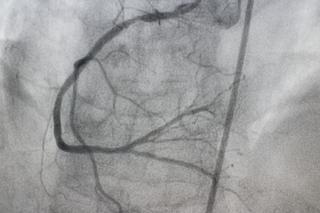 Arteriografia: badanie RTG tętnic