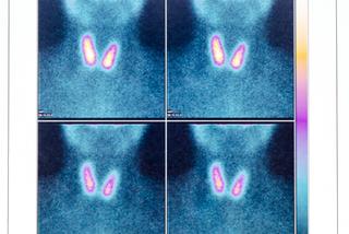 Scyntygrafia - badanie izotopowe różnych narządów