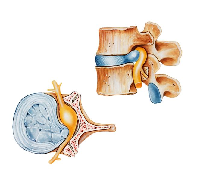 Dyskopatia